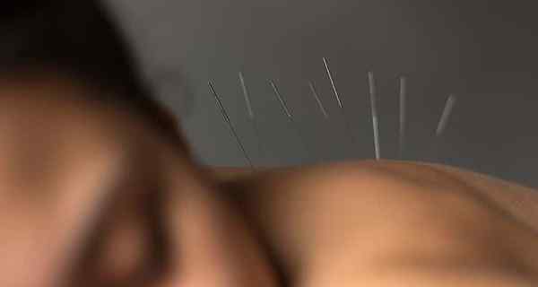 Hoe acupunctuur uw slaapstoornis kan helpen